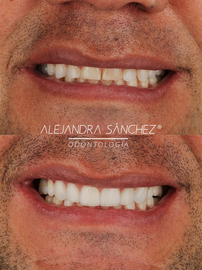 Antes y después de diseño de sonrisa en Colombia: caso masculino